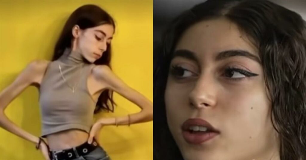 Αυτοψία: Σοκάρει μαρτυρία για τη νευρική ανορεξία στον Σρόιτερ – «Έφτασα 31 κιλά και νόμιζα ότι είμαι χοντρή»